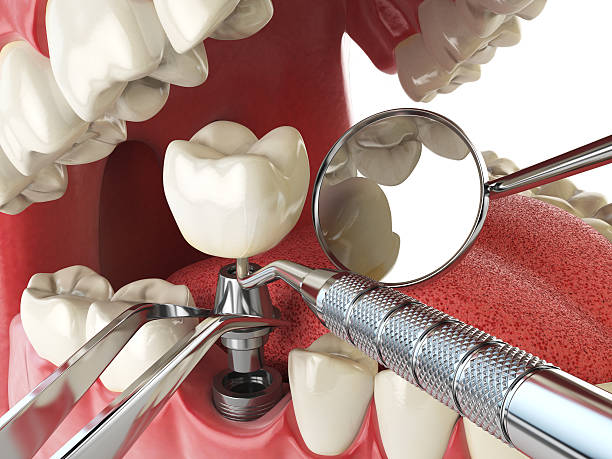Best Emergency Cosmetic Dentistry (e.g., broken veneers) in Shell Kno, MO